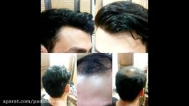 بزرگترین مرکز بافت پروتزهای مو09120614573 09198046368