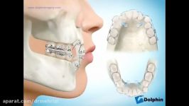 ارتودنسی دندان دستگاه ارتودنسی ثابت همراه کشیدن