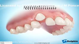متخصص ارتودنسی  ارتودنسی دندان های نیش بیرون زده