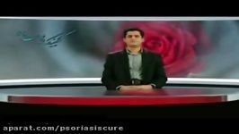 دکتر احمد عدنان در مورد پسوریازیس می گوید