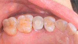 Creating a Screw Retained Temporary