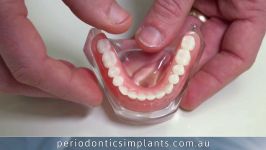 جایگزینی تمام دندان ایمپلنت های دندانی