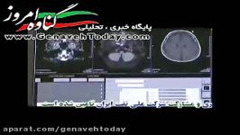 با حضور وزیر بهداشت mri کنگان به بهره برداری می رسد