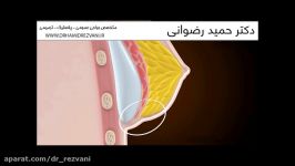 پروتز سینه  دکتر حمید رضوانی