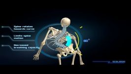  Scoliosis Animation Video 