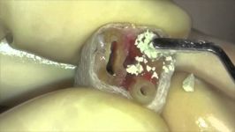 Retrograde filling during intentional replantation