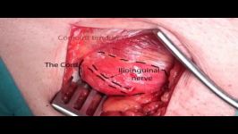 Inguinal Hernia Repair