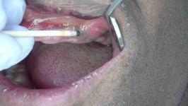 Denture Sore Spots Thompson Sticks