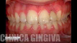 CLINICA GINGIVA.IMPLANTE INCISIVO LATERAL