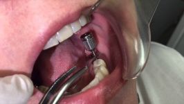 چگونگی برداشتن Healing Abutment