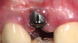 Flapless Dental Implant Removal