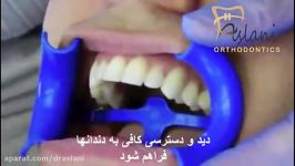 چسباندن باندینگ براکت های ارتودنسی