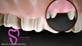 ویدیو مقایسه ایمپلنت دندان بریج دندان