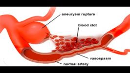 روش جدید درمان آنوریسم مغزی