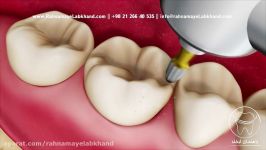 پر کردن دندان مواد همرنگ دندان