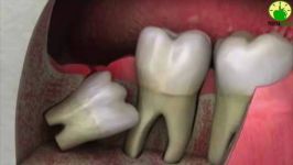 آنچه باید درباره دندان عقل بدانیم