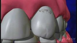 چگونگی جایگزینی ایمپلنت دندان