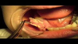 Dentigerous Cyst Marsupialization