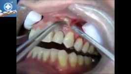 خارج کردن عفونت آبسه دندانی