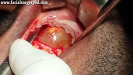 جراحی کیست دندان انوکلئاسیون کیست رادیکولار