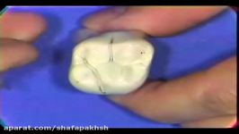 آناتومی دندان ، مرور مولارهای فک بالا Maxillary Molars