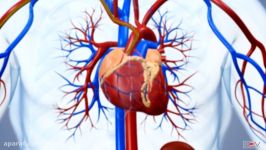 Angioplasty  Medical animation