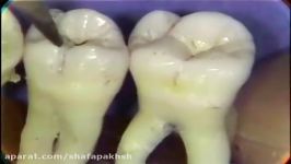 آناتومی دندان،مولارهای بالا Maxillary Molars