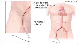 How Balloon Angioplasty is Done Animation  Coronary Angiography Procedure  Stenting in Heart Video