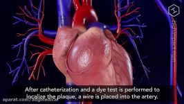 Cardiac Catheterization and Stenting