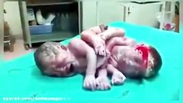 نوزاد دوقلو عجیب الخلقه چسبیده به هم