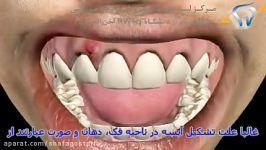 درمان ​آبسه دندان​
