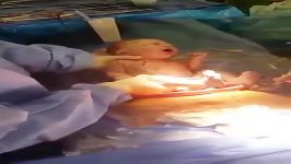 Gentle CesareanDelayed Cord Clamping C section