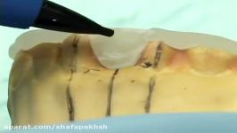 فیلم جاگذاری ابوتمنت ایمپلنت دندان،دانشگاه میشیگان