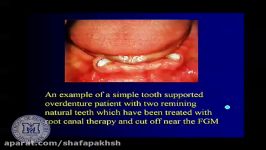 فیلم پروتز دندان Tooth supported overdentures