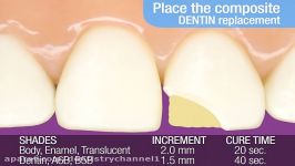 روش ساده ترمیم زیبایی دندان های قدامی کامپوزیت