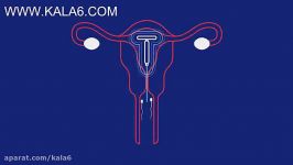 IUD چیست؟ وچگونه به عنوان یک کنترل کننده کار میکند؟