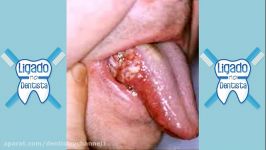 HPV دهان ویروس پاپیلومای انسانیاز طریق oral sex