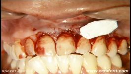 جراحی Mucogingival پیوند لثه ماتریکس کلاژن