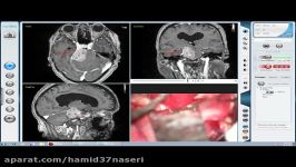 جراحی تومور قاعده جمجمه مننژیوم پتروس