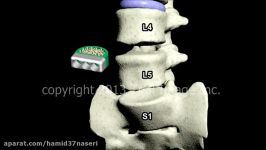 جراحی دیسک کمر قدام