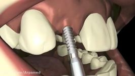 Milo 3.0mm Dental Implants Part I