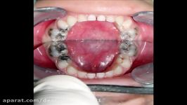 ترمیم زیبایی دندانهای قدامی در اطفال