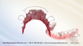 پلاک های متحرک ارتودنسی