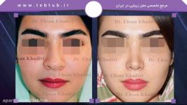 طب توب نمونه عمل های زیبایی بینی دکتر احسان خدیوی1