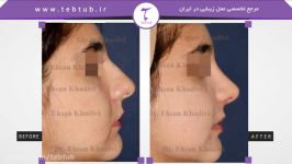 طب توب نمونه عمل های زیبایی بینی دکتر احسان خدیوی 2