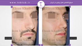 طب توب نمونه عمل های زیبایی بینی دکتر احسان خدیوی4