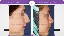 طب توب نمونه عمل های زیبایی بینی دکتر احسان خدیوی 7