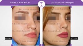 طب توب نمونه عمل های زیبایی بینی دکتر احسان خدیوی 5