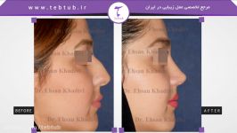 طب توب نمونه عمل های زیبایی بینی دکتر احسان خدیوی 8
