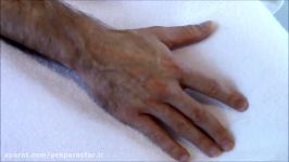 How to find a Vein in the Hand for Starting IVs